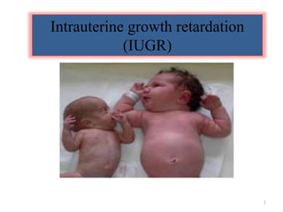 Intrauterine growth retardation
(IUGR)
By: Fikadu T.
1
 