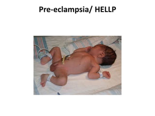 Pre-eclampsia/ HELLP
 