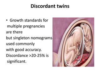 Discordant twins
• Growth standards for
multiple pregnancies
are there
but singleton nomograms are more
used commonly
with good accuracy.
Discordance >20-25% is
significant.
 