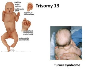 Trisomy 13
Turner syndrome
 