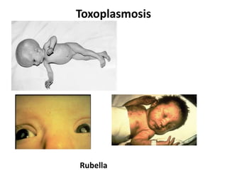 Toxoplasmosis
Rubella
 