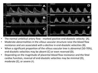 • The normal umbilical artery flow --marked positive end-diastolic velocity (A).
• Moderate abnormalities in the villous vascular structure raise the blood flow
resistance and are associated with a decline in end-diastolic velocities (B).
• When a significant proportion of the villous vascular tree is abnormal (50-70%),
end-diastolic velocities may be absent (C) or even reversed (D).
• Depending on the magnitude of placental blood flow resistance and the fetal
cardiac function, reversal of end-diastolic velocities may be minimal (D),
moderate (E), or severe (F).
 