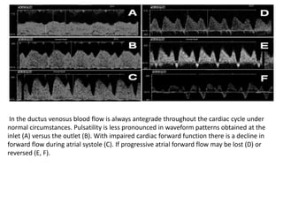 In the ductus venosus blood flow is always antegrade throughout the cardiac cycle under
normal circumstances. Pulsatility is less pronounced in waveform patterns obtained at the
inlet (A) versus the outlet (B). With impaired cardiac forward function there is a decline in
forward flow during atrial systole (C). If progressive atrial forward flow may be lost (D) or
reversed (E, F).
 