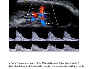 A, Color Doppler assessment of the MCA at the level of the circle of Willis. B,
Normal and abnormal(high diastolic velocities and decreased pulsatility index) C,
 