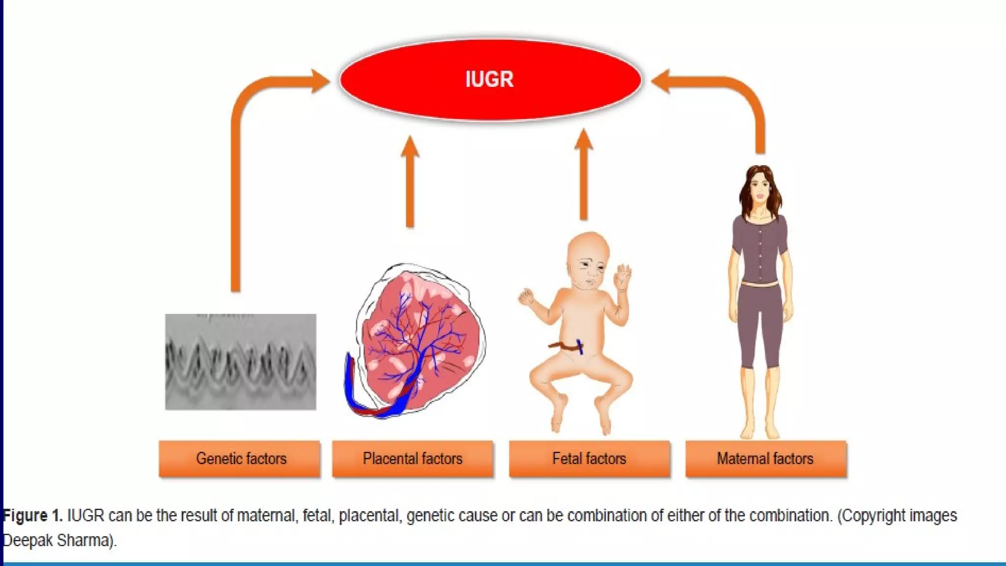 Intrauterine Growth Restriction | PPT