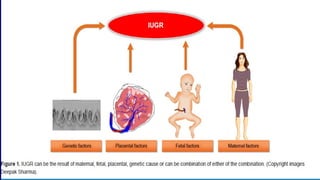 Intrauterine Growth Restriction | PPT