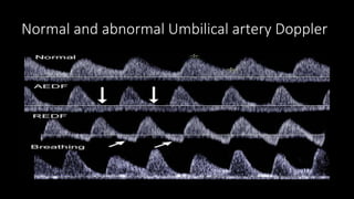 Fetal Doppler Evaluation | PPTX