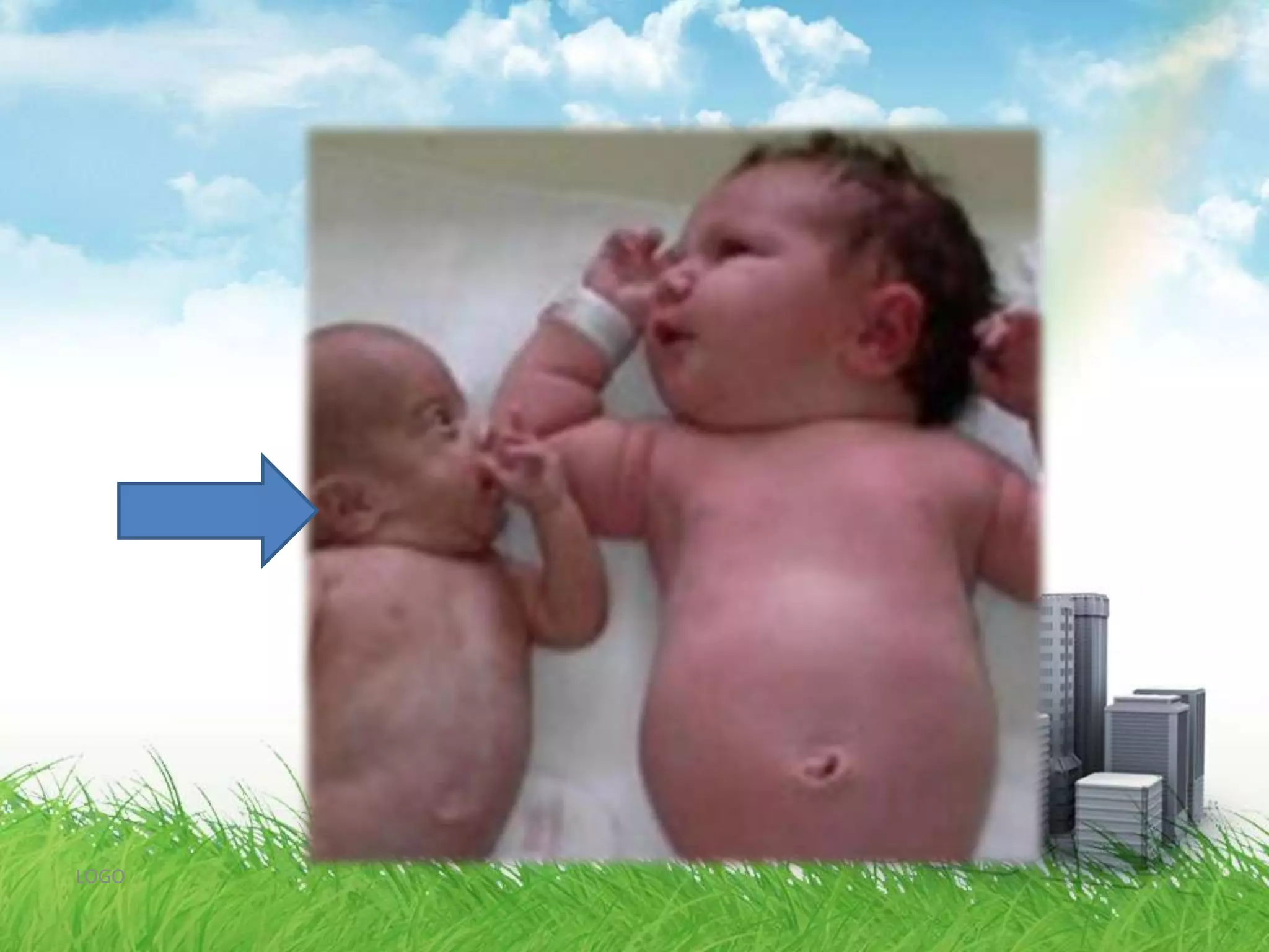 Classification1.Symmetrical growth restrictionIntrinsic factorChromosomal abnormalitiesCongenital anomaliesIntrauterine infectionLOGO