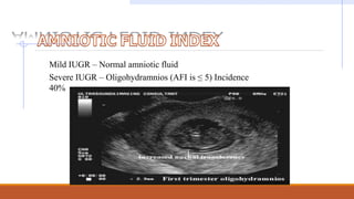 Mild IUGR – Normal amniotic fluid
Severe IUGR – Oligohydramnios (AFI is ≤ 5) Incidence
40%
 