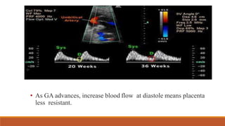 • As GA advances, increase blood flow at diastole means placenta
less resistant.
 