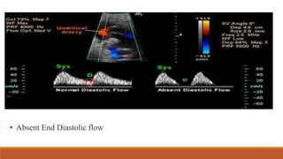 • Absent End Diastolic flow
 