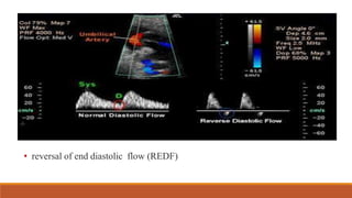 • reversal of end diastolic flow (REDF)
 
