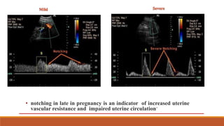 • notching in late in pregnancy is an indicator of increased uterine
vascular resistance and impaired uterine circulation’
 