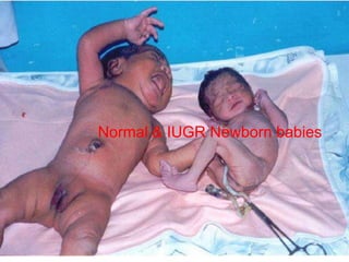 Normal & IUGR Newborn babies

 