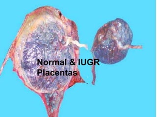Normal & IUGR
Placentas

 