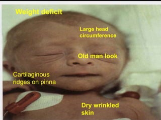 Weight deficit
Large head
circumference

Old man look
Cartilaginous
ridges on pinna

Dry wrinkled
skin

 