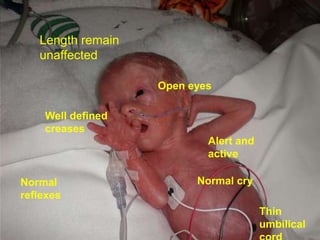 Length remain
unaffected
Open eyes
Well defined
creases
Alert and
active
Normal
reflexes

Normal cry
Thin
umbilical

 