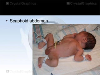 • Scaphoid abdomen

 