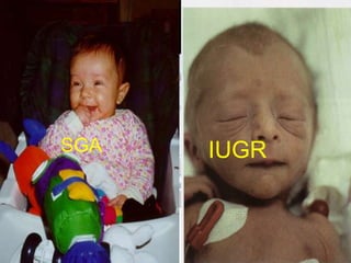 SGA

IUGR

 