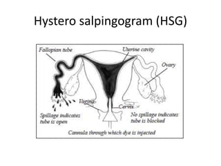 Hystero salpingogram (HSG)
 