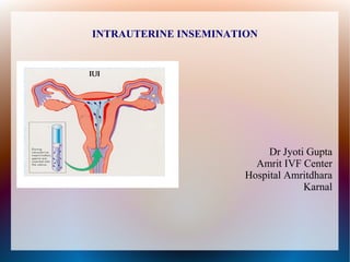 INTRAUTERINE INSEMINATION
Dr Jyoti Gupta
Amrit IVF Center
Hospital Amritdhara
Karnal
 