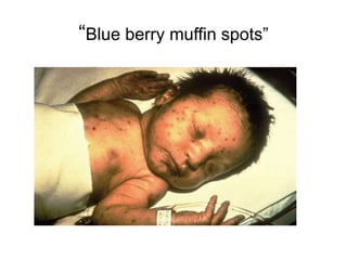 Muffin Rash Intrauterine Infections- Dr RAVINDRA G O | PPTX