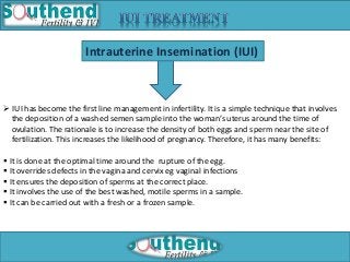 Intrauterine Insemination (IUI) 
 IUI has become the first line management in infertility. It is a simple technique that involves 
the deposition of a washed semen sample into the woman’s uterus around the time of 
ovulation. The rationale is to increase the density of both eggs and sperm near the site of 
fertilization. This increases the likelihood of pregnancy. Therefore, it has many benefits: 
 It is done at the optimal time around the rupture of the egg. 
 It overrides defects in the vagina and cervix eg vaginal infections 
 It ensures the deposition of sperms at the correct place. 
 It involves the use of the best washed, motile sperms in a sample. 
 It can be carried out with a fresh or a frozen sample. 
 