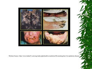 Website Source: http://www.kaheel7.com/eng/index.php/health-a-medicine/80-smoking-the-21st-epidemic-disease   