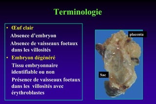 Terminologie
• Œuf clair
Absence d’embryon
Absence de vaisseaux foetaux
dans les villosités
• Embryon dégénéré
Tissu embryonnaire
identifiable ou non
Présence de vaisseaux foetaux
dans les villosités avec
érythroblastes
placenta
Sac
 