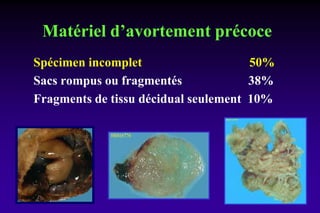 Matériel d’avortement précoce
Spécimen incomplet 50%
Sacs rompus ou fragmentés 38%
Fragments de tissu décidual seulement 10%
 