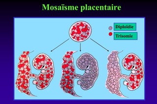 Mosaïsme placentaire
Trisomie
Diploïdie
 