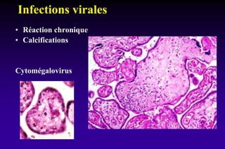 Infections virales
• Réaction chronique
• Calcifications
Cytomégalovirus
 