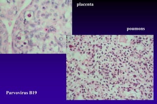 Parvovirus B19
placenta
poumons
 