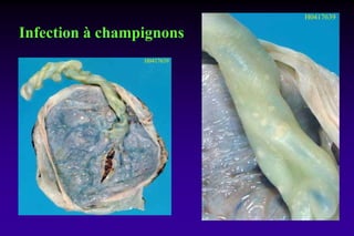 Infection à champignons
 