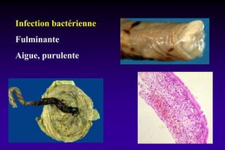 Infection bactérienne
Fulminante
Aigue, purulente
 