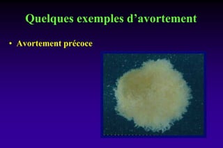 Quelques exemples d’avortement
• Avortement précoce
 