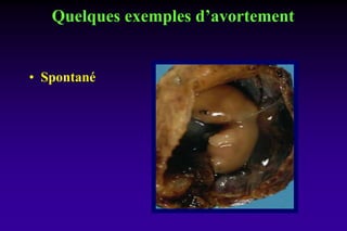 Quelques exemples d’avortement
• Spontané
 