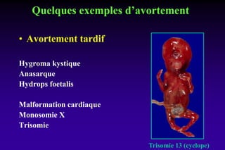 Quelques exemples d’avortement
• Avortement tardif
Hygroma kystique
Anasarque
Hydrops foetalis
Malformation cardiaque
Monosomie X
Trisomie
Trisomie 13 (cyclope)
 