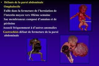 • Défauts de la paroi abdominale
Omphalocèle
Faille dans la fermeture de l’herniation de
l’intestin moyen vers 10ième semaine
Sac membraneux composé d’amnion et de
péritoine
Associé fréquemment à d’autres anomalies
Gastrochisis défaut de fermeture de la paroi
abdominale
 