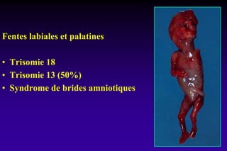 Fentes labiales et palatines
• Trisomie 18
• Trisomie 13 (50%)
• Syndrome de brides amniotiques
 