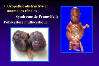 • Uropathie obstructive et
anomalies rénales
Syndrome de Prune-Belly
Polykystose multikystique
 
