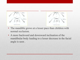 • The mandible grows at a lesser pace than children with
normal occlusion.
• A more backward and downward inclination of the
mandibular body leading to a lesser decrease in the facial
angle is seen .
 