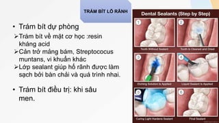 • Trám bít dự phòng
• Trám bít điều trị: khi sâu
men.
Trám bít về mặt cơ học :resin
kháng acid
Cản trở mảng bám, Streptococus
muntans, vi khuẩn khác
Lớp sealant giúp hố rãnh được làm
sạch bởi bàn chải và quá trình nhai.
TRÁM BÍT LỖ RÃNH
 