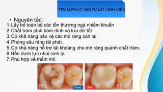 • Nguyên tắc:
1.Lấy bỏ toàn bộ các tổn thương ngà nhiễm khuẩn
2.Chất trám phải bám dính và lưu dữ tốt
3.Có khả năng bảo vệ các mô răng còn lại,
4.Phòng sâu răng tái phát.
5.Có khả năng hỗ trợ tái khoáng cho mô răng quanh chất trám.
6.Bền dưới lực nhai sinh lý.
7.Phù hợp về thẩm mỹ.
TRÁM PHỤC HỒI RĂNG VĨNH VIỄN
 