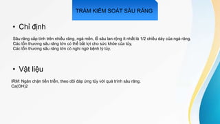 • Chỉ định
• Vật liệu
Sâu răng cấp tính trên nhiều răng, ngà mền, lỗ sâu lan rộng ít nhất là 1/2 chiều dày của ngà răng.
Các tổn thương sâu răng lớn có thể bất lợi cho sức khỏe của tủy,
Các tổn thương sâu răng lớn có nghi ngờ bệnh lý tủy.
IRM: Ngăn chặn tiến triển, theo dõi đáp ứng tủy với quá trình sâu răng.
Ca(OH)2
TRÁM KIỂM SOÁT SÂU RĂNG
 
