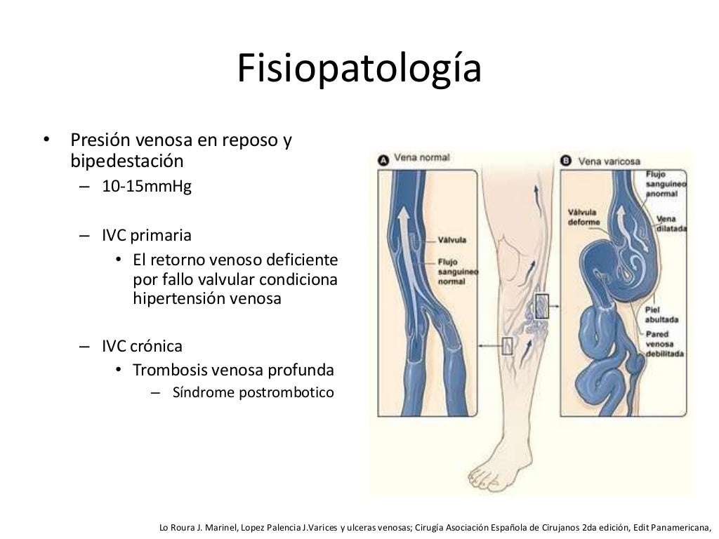 INSUFICIENCIA VENOSA