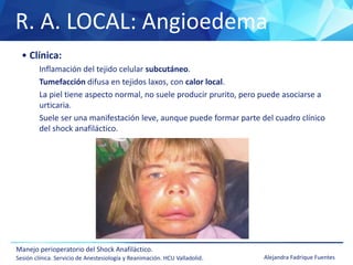 R. A. LOCAL: Angioedema
Manejo perioperatorio del Shock Anafiláctico.
Sesión clínica. Servicio de Anestesiología y Reanimación. HCU Valladolid. Alejandra Fadrique Fuentes
• Clínica:
Inflamación del tejido celular subcutáneo.
Tumefacción difusa en tejidos laxos, con calor local.
La piel tiene aspecto normal, no suele producir prurito, pero puede asociarse a
urticaria.
Suele ser una manifestación leve, aunque puede formar parte del cuadro clínico
del shock anafiláctico.
 