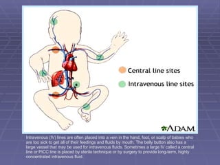 Intravenous (IV) lines are often placed into a vein in the hand, foot, or scalp of babies who are too sick to get all of their feedings and fluids by mouth. The belly button also has a large vessel that may be used for intravenous fluids. Sometimes a large IV called a central line or PICC line is placed by sterile technique or by surgery to provide long-term, highly concentrated intravenous fluid. 