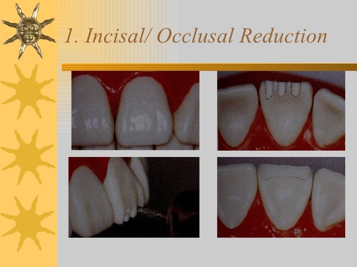 Iv.tooth prep v. occlusion