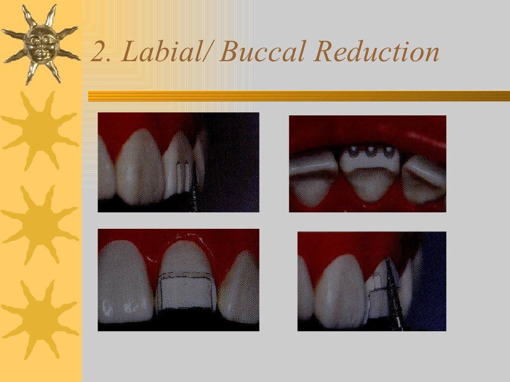 Iv.tooth prep v. occlusion
